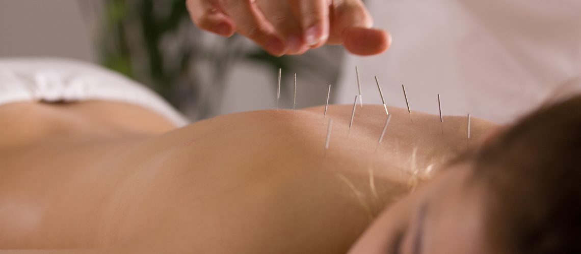 The doctor sticks needles into thegirl's body on the acupuncture, close-up